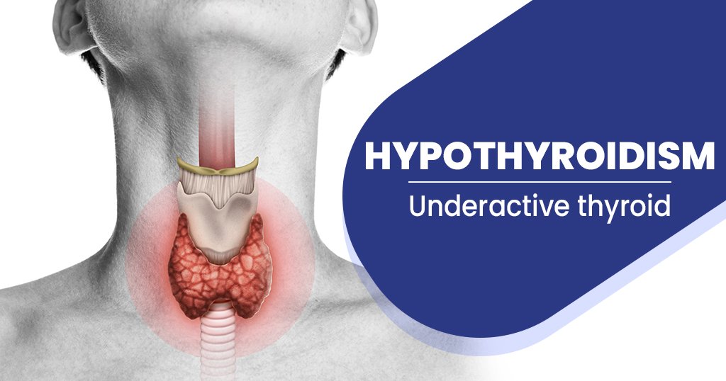 Hypothyroidism: Causes, Symptoms, & Treatment