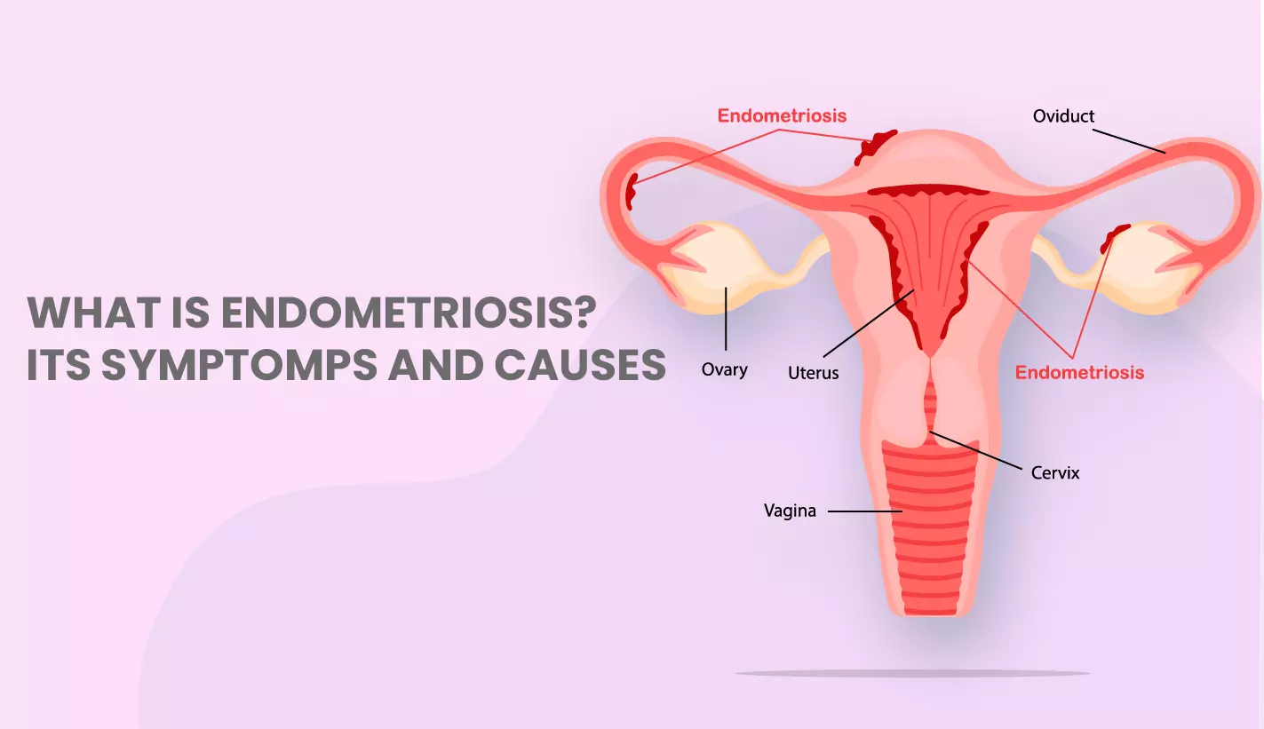 Endometriosis Explained: How It Impacts Your Fertility Journey